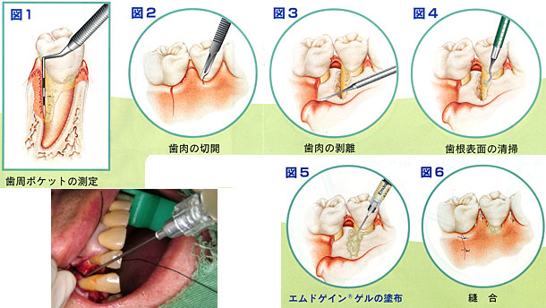 歯周再生療法 エムドゲインゲルの塗布 - 槙原歯科 豊洲インプラント